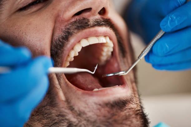 Best Emergency Wisdom Teeth Removal in Prudenville, MI